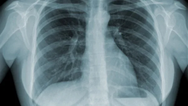 x-ray